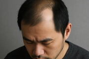 아시아 면역세포 지도 완성…韓 원형탈모 높아